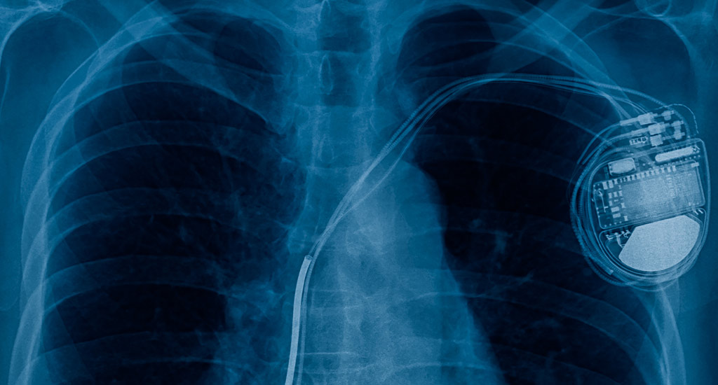 Specialized medical device tubing for pacemaker manufacturers in stainless steel and titanium alloys